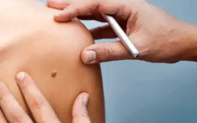 Ο ήλιος εκτός από την προσωρινή ‘σοκολατένια’ απόχρωση, αφήνει στο μέλλον και ένα αφυδατωμένο, γηρασμένο γεμάτο δυσχρωμίες δέρμα